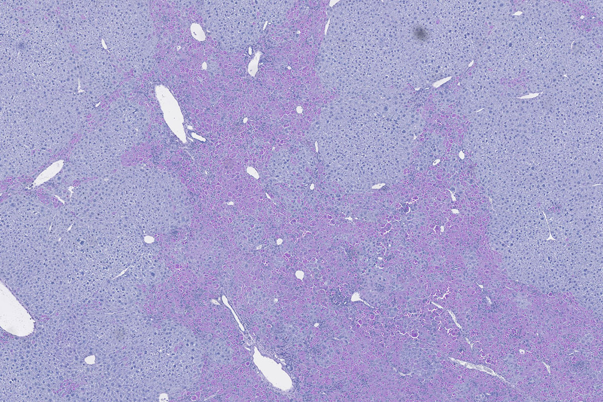 New clues to disease severity identified in alpha1-antitrypsin deficiency