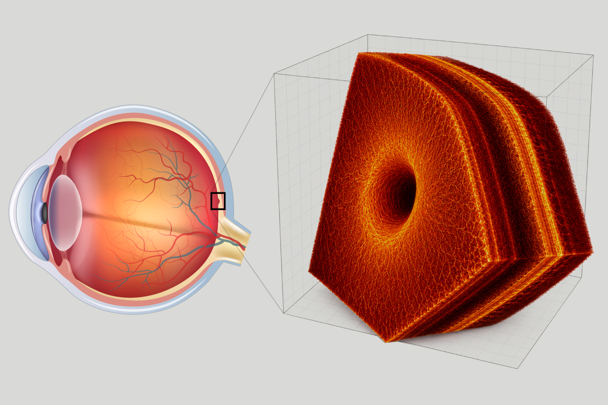 New AI tools could help eye doctors diagnose retinal disease faster