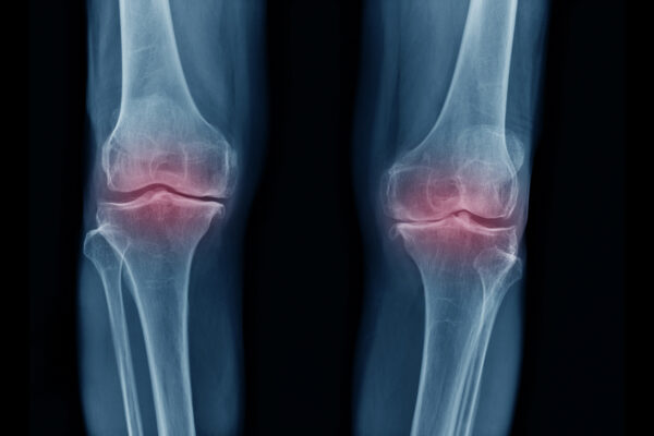 Osteoarthritis therapy study advances with $17 million from ARPA-H